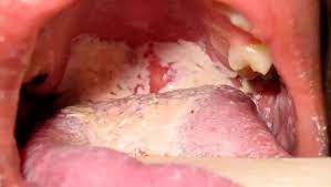 lây nhiễm bệnh lậu qua quan hệ đường miệng