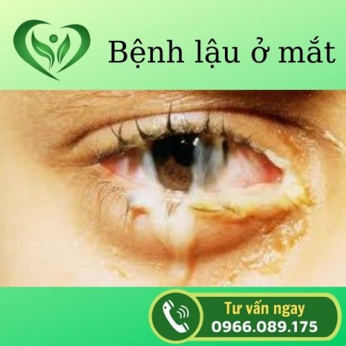 Bệnh lậu ở mắt: Nguyên nhân, triệu chứng và cách chữa lậu mắt hiệu quả