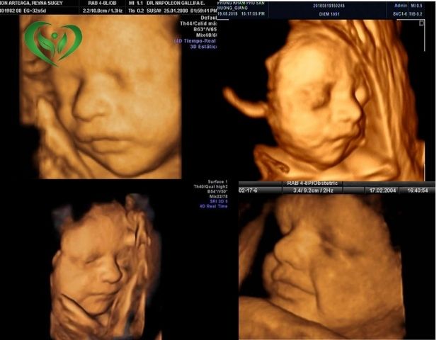 Hình ảnh siêu âm 4D thai 24 tuần