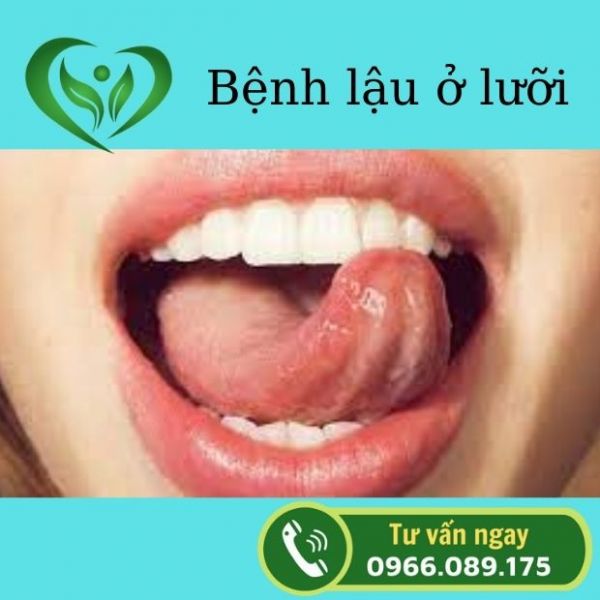 Bệnh lậu ở lưỡi, nguyên nhân, triệu chứng và cách chữa hiệu quả
