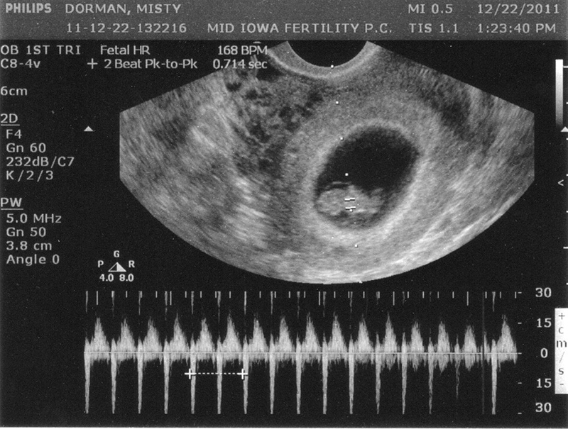 Hình ảnh tim thai 7 tuần tuổi