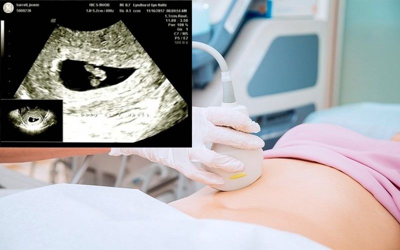Hình ảnh bình thường siêu âm thai 3 tháng đầu  Bác Sĩ Đa Khoa