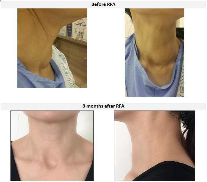 hình ảnh so sánh trước và sau điều trị u tuyến giáp bằng RFA