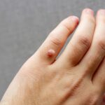 Giá đốt hạt cơm sóng cao tần thay đổi tùy thuộc vào từng cơ sở y tế