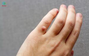 Giá đốt hạt cơm sóng cao tần thay đổi tùy thuộc vào từng cơ sở y tế