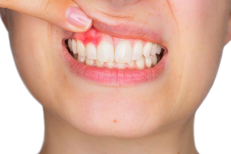  Nướu sưng và đau, chảy máu chân răng cũng có thể là dầu hiệu có thai sau quan hệ 3 ngày