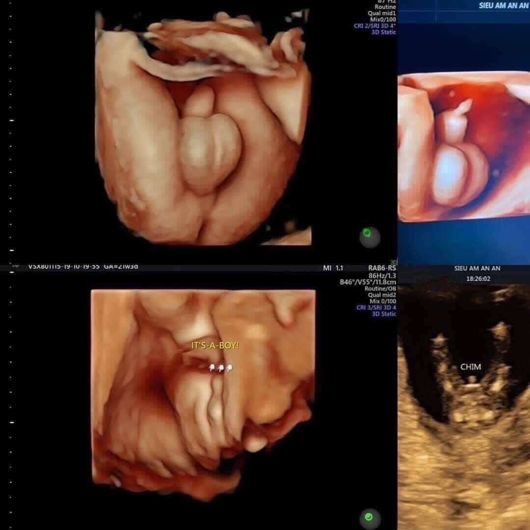 Dấu hiệu mang thai bé trai