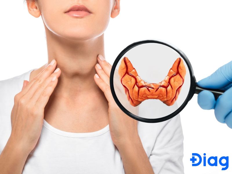bài thuốc nam chữa u tuyến giáp