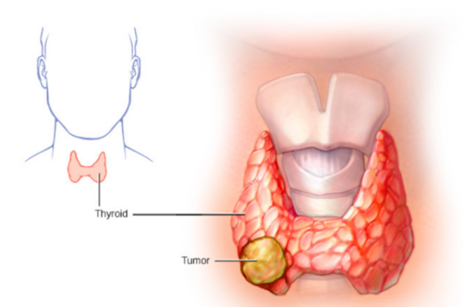 mổ u tuyến giáp 