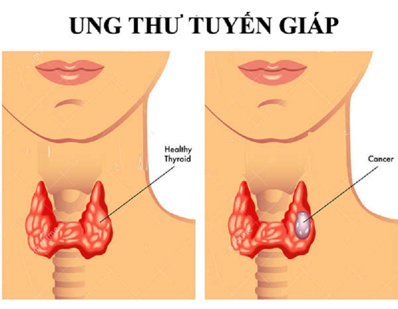 biểu hiện u tuyến giáp ác tính