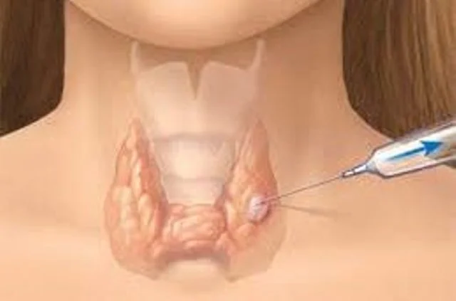 hút dịch u nang tuyến giáp bao nhiêu tiền