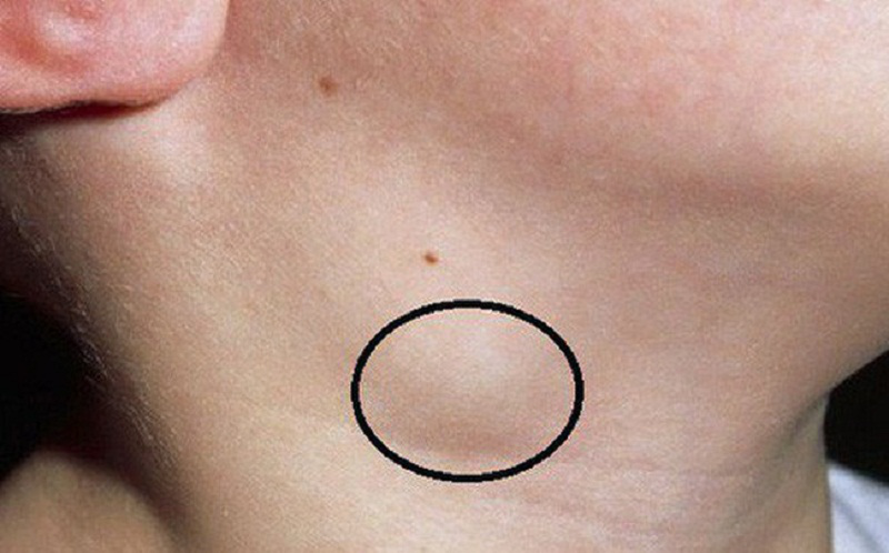 u tuyến giáp giai đoạn đầu