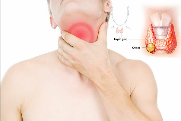 u tuyến giáp giai đoạn 2