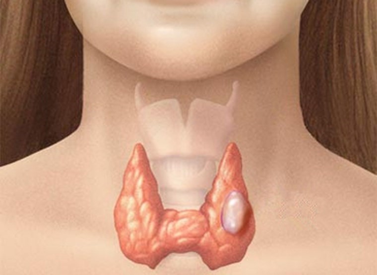 u nang tuyến giáp 5mm