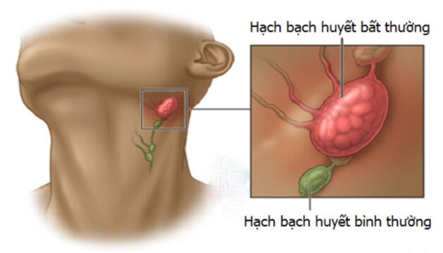 ung thư Tuyến Giáp Di Căn Hạch