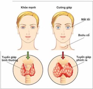 u tuyến giáp có phải cường giáp không