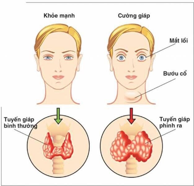 u tuyến giáp có phải cường giáp không