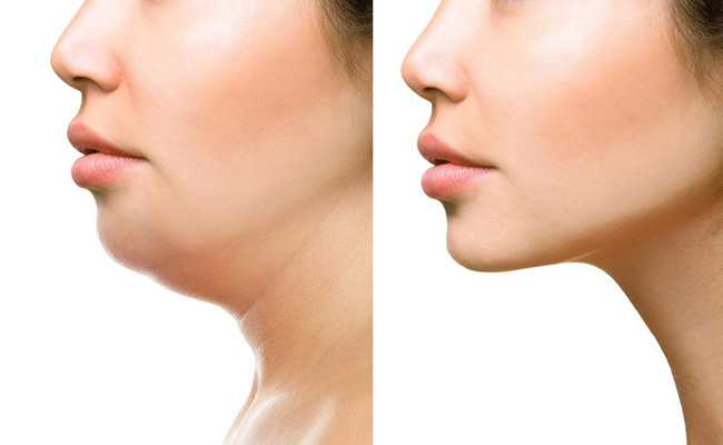 Cổ To Có Phải U Tuyến Giáp Không