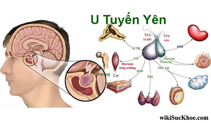 Chẩn đoán cường giáp do u tuyến yên